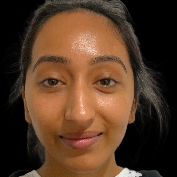 ethnic-rhinoplasty-before